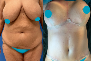 Breast reduction + Tummy tuck +Liposuction