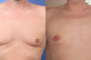 Male-mastectomy_web_1