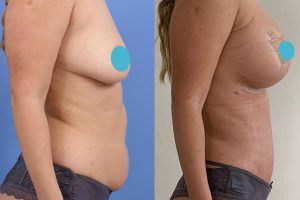Breast enlargement + Tummy tuck