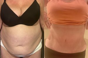 Tummy tuck + Waist and bra line liposuction + fat transfer to hip dips