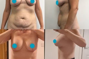 Tummy tuck + waist liposuction + breast lift with implants