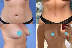 Breast reduction + Tummy tuck