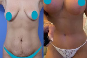 Tummy tuck + Breast lift with implants + Liposuction