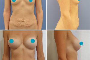 Tummy tuck + breast enlargement