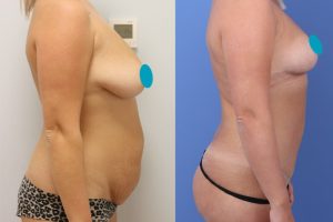 Tummy tuck + 360 circumferential liposuction + breast lift