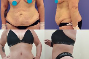 Tummy tuck + Breast enlargement and lift