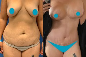 Circumferential tummy tuck + Breast lift with implants + waist liposuction