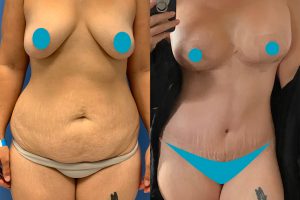 Breast lift with implants +  tummy tuck + waist liposuction