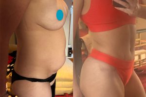 Tummy tuck + breast enlargement and lift + waist liposuction