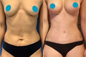 Tummy tuck + breast enlargement