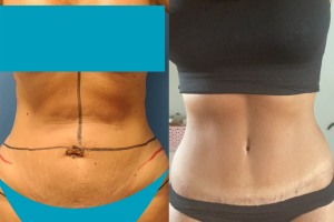 Fat transfer to hip dips + Tummy tuck + Liposuction