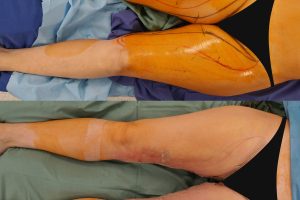 Thigh lift before and after 1