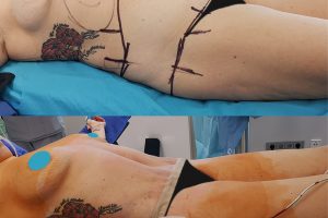 Circumferential tummy tuck + Liposuction