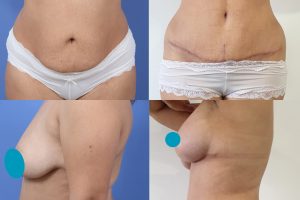 Tummy tuck + Breast lift + Implants + Liposuction