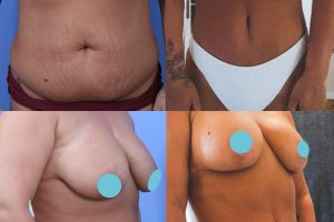 Tummy tuck + Breast lift with implants + Liposuction