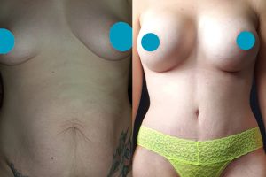 Breast implants + Tummy tuck