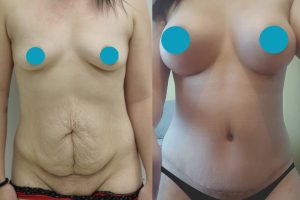 Breast enlargement + Tummy tuck