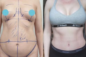 Tummy-tuck +breast enlargement