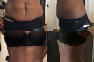 Liposuction + Tummy tuck