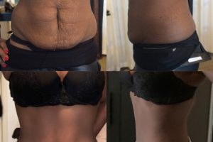 Tummy tuck + Liposuction