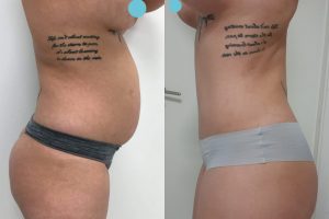 Tummy tuck + Liposuction