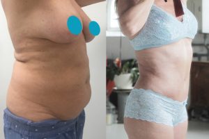 Tummy-tuck-liposuction-5