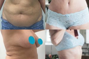 Tummy-tuck-liposuction-6-3