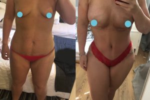 Waist liposuction + Tummy tuck + Breast implants
