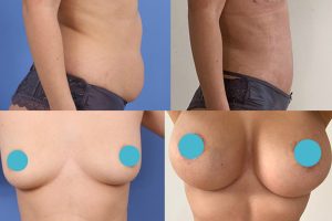 Breast implants + Tummy tuck + Liposuction