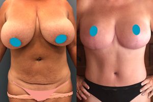Tummy tuck + waist liposuction + breast reduction