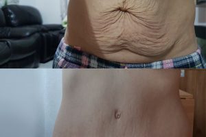 Abdominoplastia + Liposucción