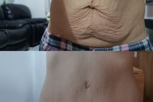 Waist liposuction + Tummy tuck