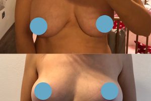 Breast implants change + breast lift