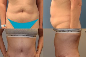 Tummy tuck + waist liposuction + bra line area liposuction
