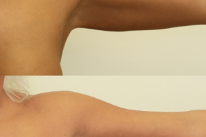 arm-lift-before-after-photo-3.png