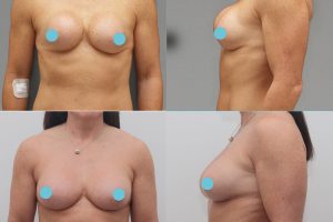 Замена грудных имплантов