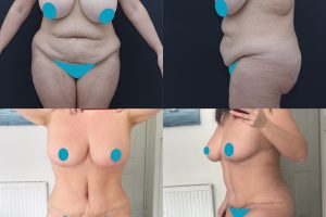 Breast reduction + Tummy tuck + Liposuction