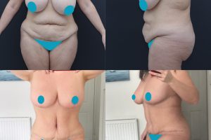 Tummy tuck + Breast reduction + Liposuction