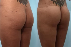buttock-lift-before-after-photo-1.jpg